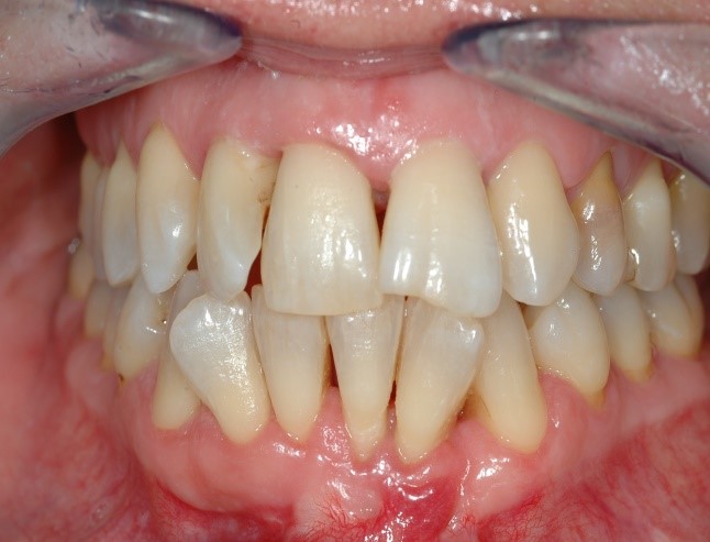 Injerto de encía - Tratamiento de encías - Clínica dental Merino