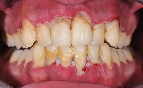 Periodontitis / Piorrea - Clínica dental Merino