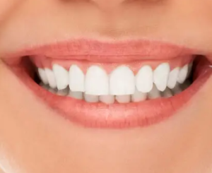 blanquemaiento dental - Clínica dental merino