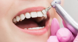 Limpieza de boca - Clínica dental Merino