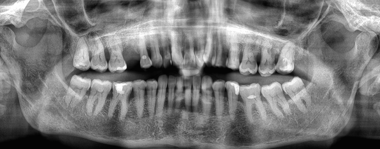 periodontitis
