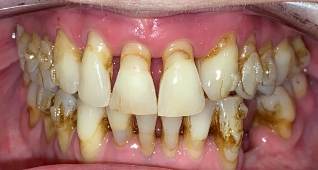 PERIODONTITIS